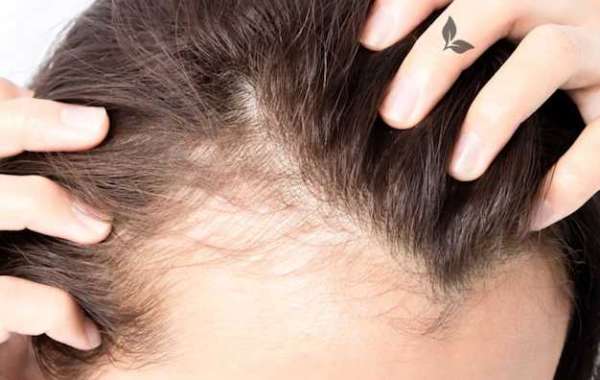 How Does Hair Loss Affect the Everyday Life Of Women?