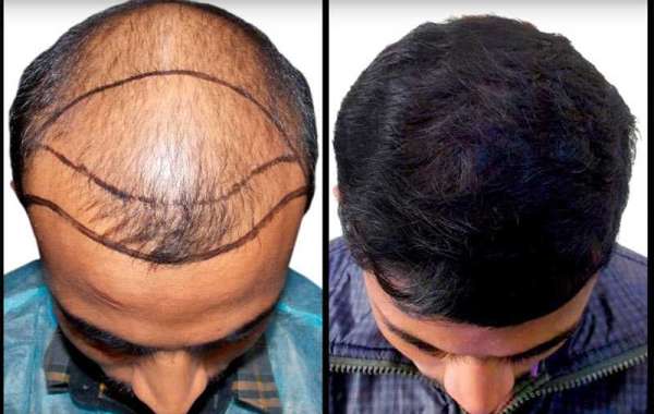 Hair Transplant in Delhi