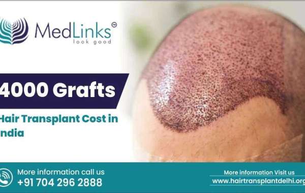 4000 Grafts Hair Transplant Cost in India 2024